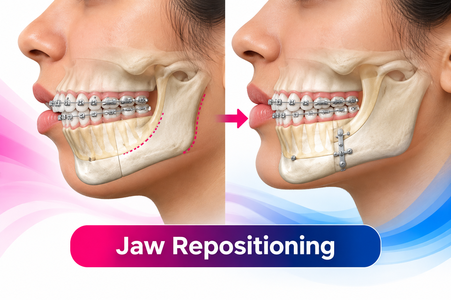 Orthognathic surgical procedures